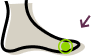 Illustration of hammer toe foot condition, showing bent toe joint deformity.